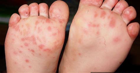 Hand foot and mouth disease treatment. Several FSU Students Diagnosed with Hand, Foot and Mouth ...