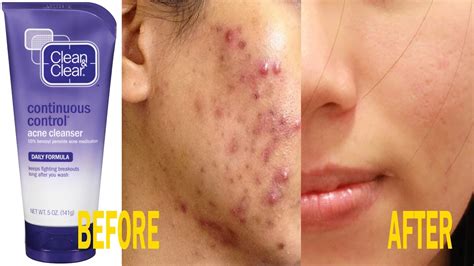 There are numerous acne scar treatments that do help. The best moisturizer for oily and acne prone skin| Remove ...