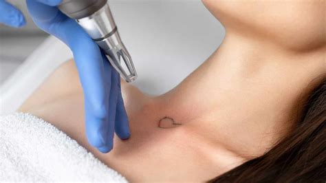 Stanley castor, md board certified plastic surgeon Laser Tattoo Removal - Ellan Laser MedSpa