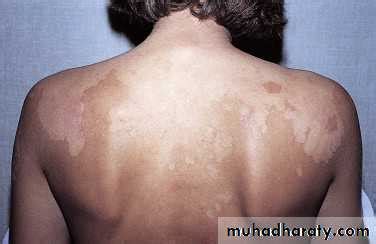 If the white spots on the skin are areas where there is no pigmentation in the skin it is quite possibly vitiligo. Superficial fungal infection pptx - د.عمر - Muhadharaty
