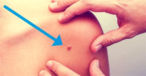 Sometimes cancer can be detected simply by looking at your skin, but the only way to accurately diagnose melanoma is with a biopsy. When Do You Know if Your Mole is Cancerous? - ATTN: