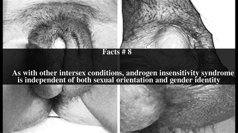 Intersexualism (ibland intersexualitet eller intersex) beskriver anatomiska skillnader hos en individ som innebär att kroppen och anatomin, inkluderat gener, könshormoner och/eller könsorgan, inte entydigt kan kategoriseras som man eller kvinna. Androgen insensitivity syndrome Top # 19 Facts - YouTube