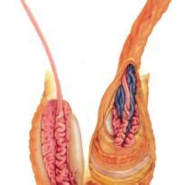 Varicocele is a term used to describe abnormally dilated veins (called the pampiniform plexus of how does a varicocele form? Varicocele left 1 or 2: treatment of a left varicocele testis