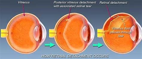 Retinal detachment is a disorder of the eye in which the retina peels away from its underlying layer of support tissue. India Surgery Tour | Retinal Detachment Surgery in India ...