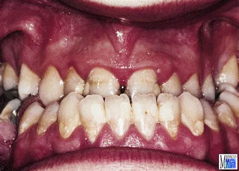 Occlusion and occlusal characteristics of primary dentition in north indian children of east lucknow region. mesial occlusion - Liberal Dictionary