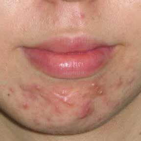 Furthermore, it affects various parts of the body including. Top 6 Home Remedies to Get Rid of Chin Acne | Acne cure ...