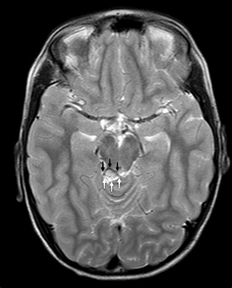 Figure 1 examples of mri artifact: Image | Radiopaedia.org