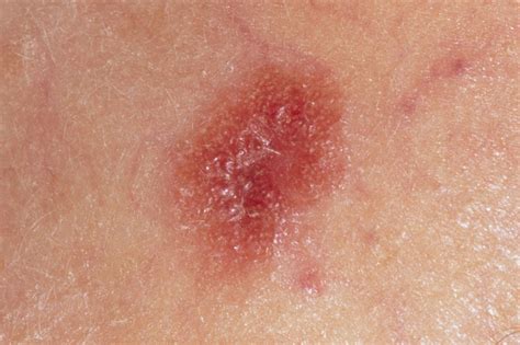 Skin cancers are one of the common cancers in the world population. Skin cancer (melanoma) - NHS