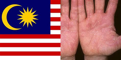There are several potential risk factors for als. Skin Disease in Malaysia
