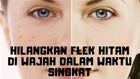 Cara menghilangkan merkuri di wajah. Cara Menghilangkan Flek Hitam Di Wajah Yang Membandel ...