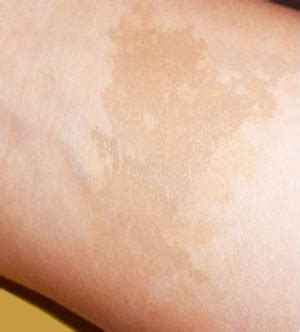 They are caused by a col. Café-au-lait Birthmarks — HarpMed