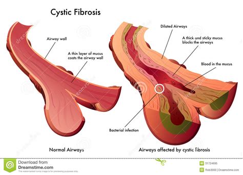 The main characteristic is a mutation in cftr, a revision article. Fibrose cística ilustração do vetor. Ilustração de ...