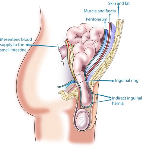 Data and dicom images stocked on our pacs (picture archiving and communicating system) were processed and exported as jpeg images. Inguinal Hernia Perth | Hernia Repair Surgery | Upper ...