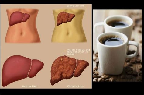 Usually, once you are able to to take thin liquids, which for most people is the next day after surgery. Drink Coffee to Save the Liver from Alcohol Damage - In ...
