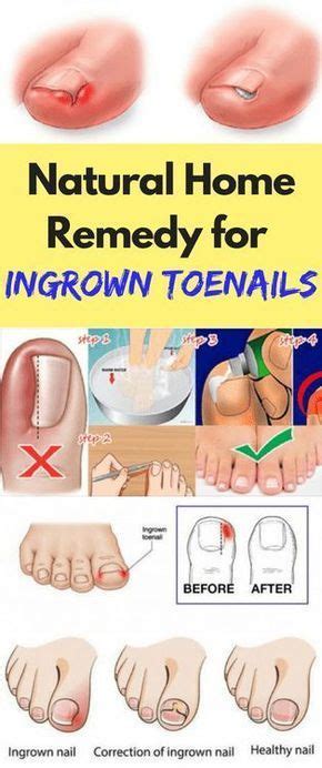 Mix the oil with water to dilute it, and apply using a cotton ball. Home Remedies to Get Rid Of Ingrown Toenails | Ingrown toe ...