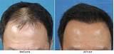 Hair Loss Concealer Side Effects Photos