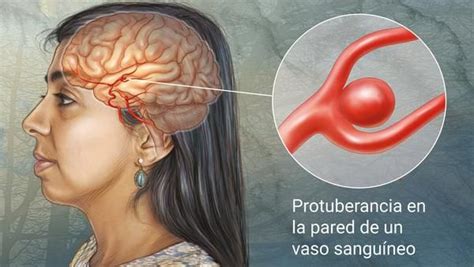 This provides an image of the blood vessels in the brain to detect a problem with. Aneurisma Cerebral / Aneurisma Cerebral Fleni : Aneurisma cerebral — saltar a navegación ...