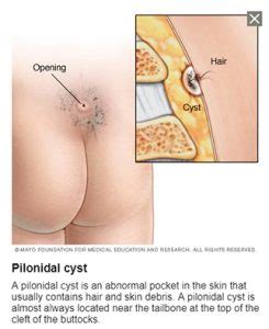The wound will need 1 to 2 months to heal. Pilonidal cyst recovery time - things to know after surgery