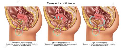 Section for human anatomy at the department of medical cell biology, uppsala university, sweden. Types of Incontinence in Female Anatomy - Stock Image ...