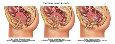 Anatomical knowledge of the coeliac trunk and its branches is indispensable for surgeons in order. Types of Incontinence in Female Anatomy - Stock Image ...