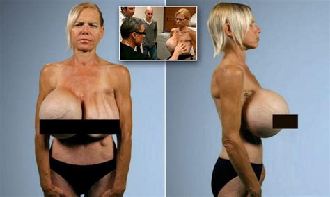 However, flagging something does not mean that it gets automatically removed. : A woman who had her 30-POUND breast implants removed ...