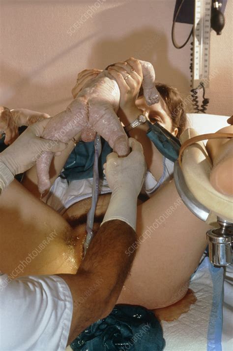 Woman giving birth in hospital - Stock Image - M810/0171 ...