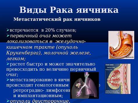 Рак яичников диета Рак яичников - презентация онлайн Рак яичников - презентация онлайн Рак яичников диета