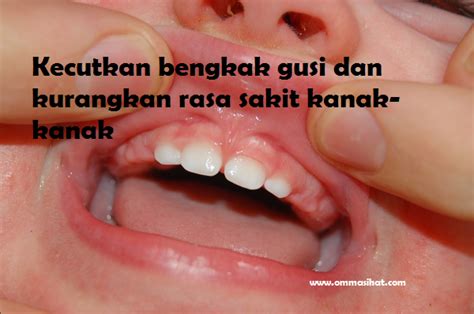 Terkadang, benjolan bisa berukuran penyakit graves atau gondokan merupakan kondisi autoimun dimana sel imunitas tubuh menyerang kelenjar tiroid karena produksi hormon yang. Cara Merawat Bengkak Gusi Dan Berdarah Pada Kanak-Kanak ...