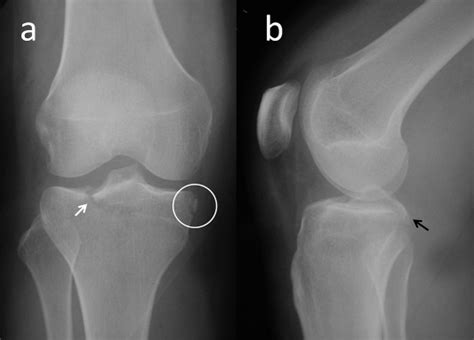 Reverse Segond fracture and associated knee injuries: A ...