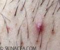 Here are 10 ways to get rid of them. How to Get Rid of Ingrown Hair | Skinacea.com