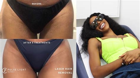 Ingrown leg hair hair irritation infected hair follicle ingown hair tweezer leg tweezers leg laser hair removal treatment laser hair removal armpit science acne laser hair removal vector. How I got rid of my Bikini Ingrown Hairs? - Laser Hair ...