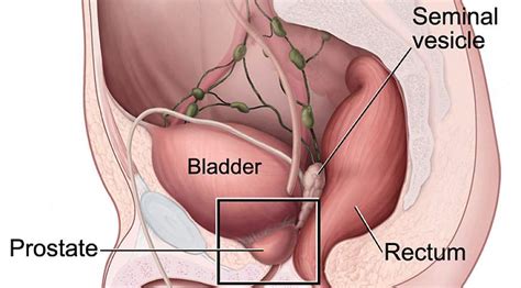 Some common signs of metastatic cancer include: NIH-funded study shows increased survival in men with ...