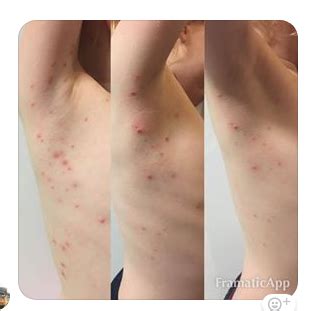 The time that it takes for the virus to run its course varies between people, but it can take two months to four years. Molluscum contagiosum - (children) (208) - Dr Wheatgrass