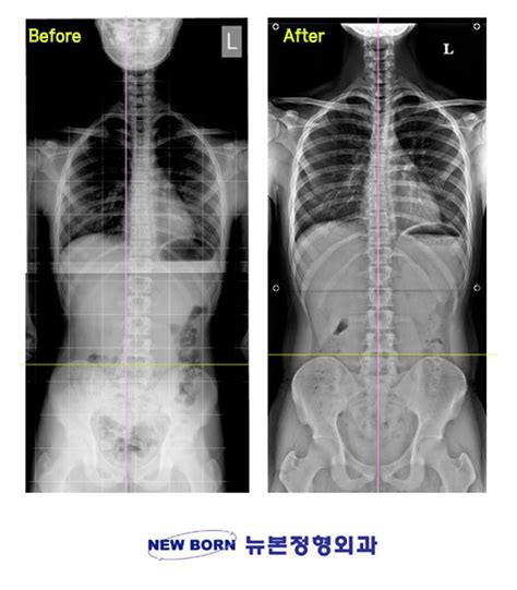 골반 비대칭, 척추측만증, 다리길이차이) 교정 전/후