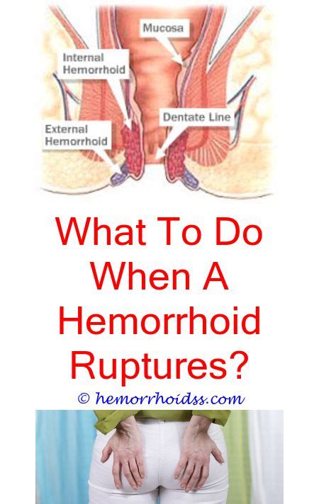 Put your feet on a small stool during bowel movements to change the position of your rectum. Pin on How To Treat Hemorrhoids