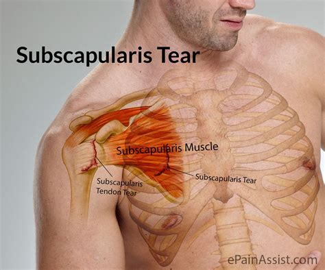 Muscles move the bones by pulling on the tendons. Subscapularis tear includes the tear of the subscapularis ...