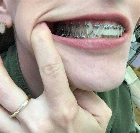 How often should you change your elastics (rubber bands) for braces? Pin on Braces