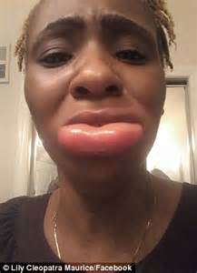 Gingivitis causes swelling of the lips. Florida woman Lily Cleopatra Maurice rushed to ER with ...