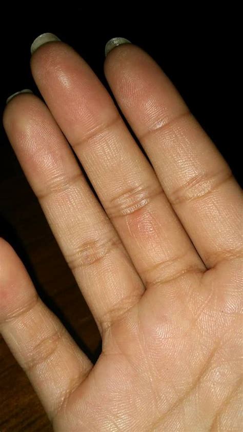 Rawatan ketuat boleh menggunakan ubat seperti salicylic acid ataupun duofilm. Langkah Mudah Buang Ketuat Tanpa Beli Ubat Di Farmasi ...