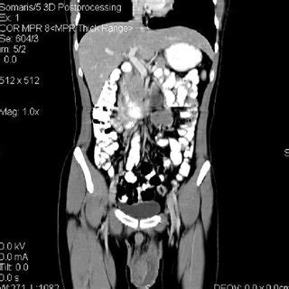 We did not find results for: (PDF) Hydrocele with a surprise: Malignant mesothelioma of ...