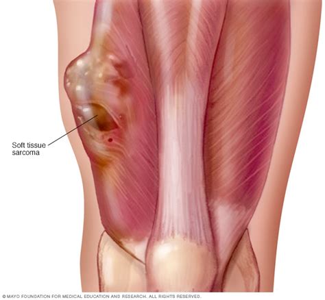 Function of the rib cage. Soft tissue sarcoma Disease Reference Guide - Drugs.com