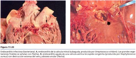 Abscesos intramiocárdicos que afectarían los anillos valvulares. patologia 2013