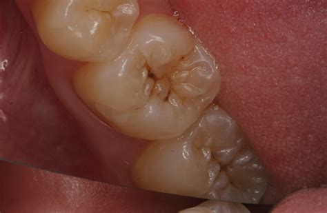 Look for missing pieces or unusual marks on the tooth. Ways to Tell if You Have a Cavity