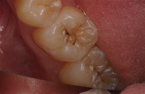 These can be visible, but they may not be. Ways to Tell if You Have a Cavity