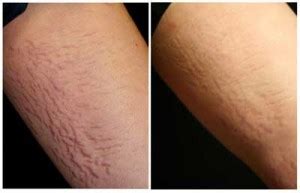 Often, they simply refuse to go away. Thigh Stretch Marks, Skin Condition and Cosmetic ...