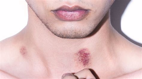 Definition of hickey in the idioms dictionary. How to get rid of a hickey, if you somehow are still ...