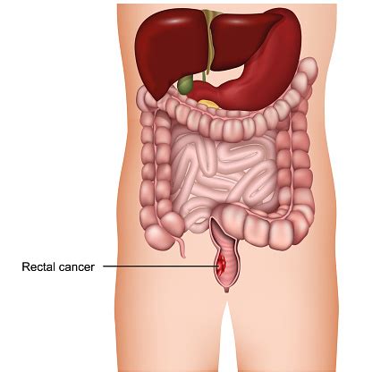 Do i need a second opinion regarding my colon or rectal cancer diagnosis? Rectal Cancer Medical 3d Vector Illustration On White ...