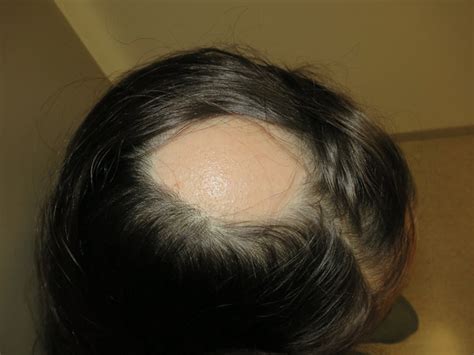 The loss of nutrients long term can contribute to many problems, one of which is hair loss. TOURETTE´S SYNDROME AND NON-CELIAC GLUTEN SENSITIVITY ...