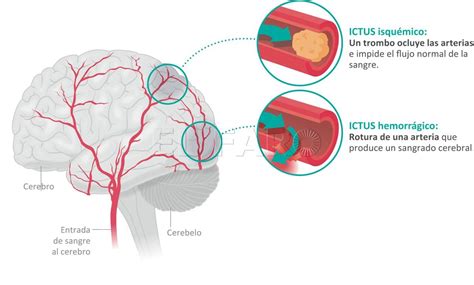 Las causas de muerte cerebral pueden ser múltiples, las mas usuales son el traumatismo encéfalo craneano, la hemorragia subaracnoídea y la isquemia cerebral global a causa de un paro. Accidente cerebrovascular (ICTUS)