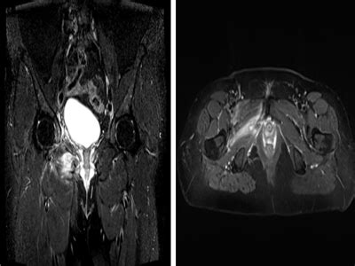 Bilateral Stress Fractures of Pubic Ramus in a Patient ...